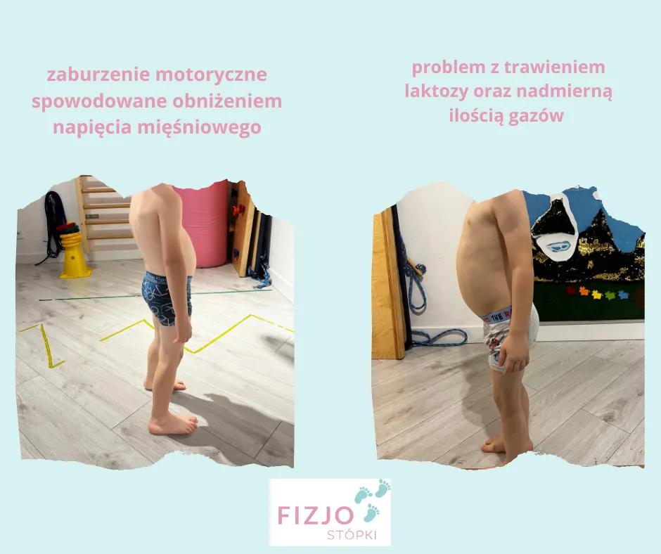 wystający brzuszek u dzieci